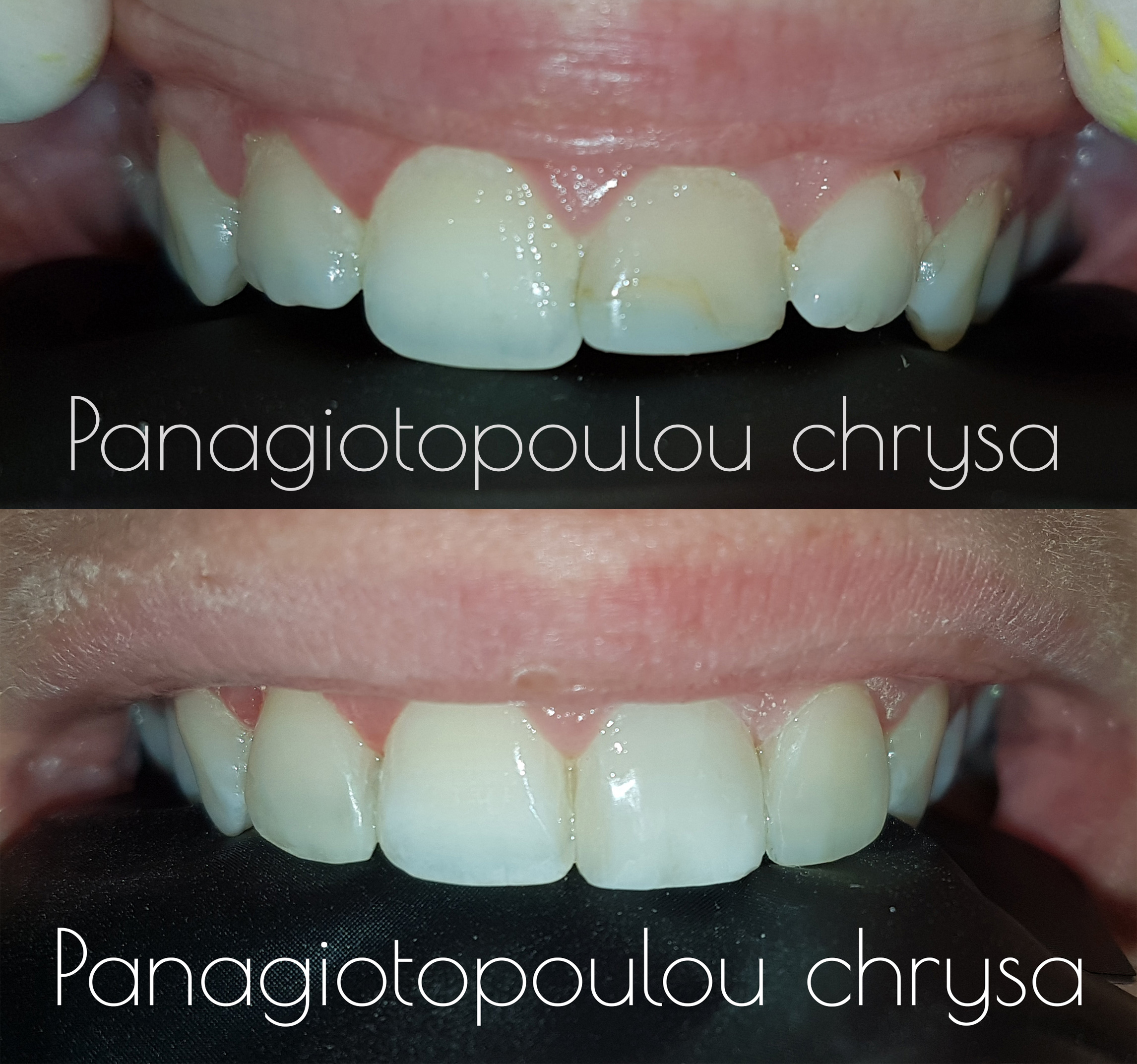 όψη ρητίνης καρδίτσα λέυκανση