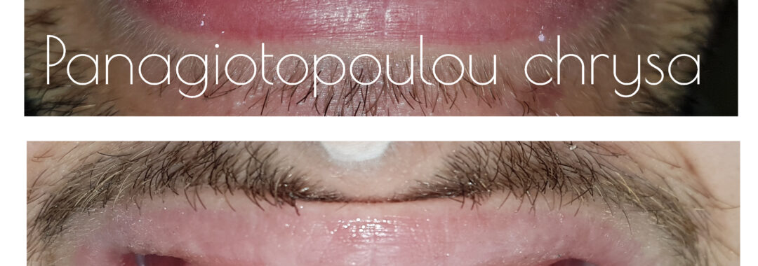 όψεις ρητίνης για κλείσιμο μεσοδιαστημάτων στα πρόσθια δόντια