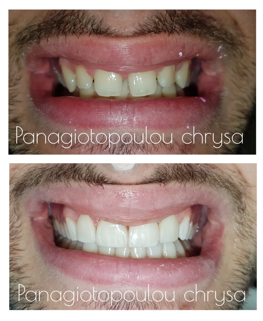 όψεις ρητίνης για κλείσιμο μεσοδιαστημάτων στα πρόσθια δόντια