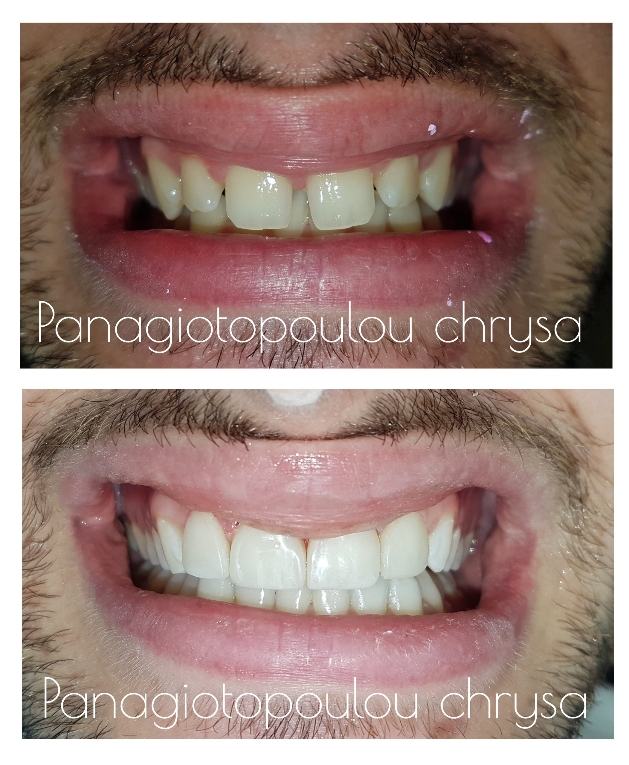 όψεις ρητίνης για κλείσιμο μεσοδιαστημάτων στα πρόσθια δόντια