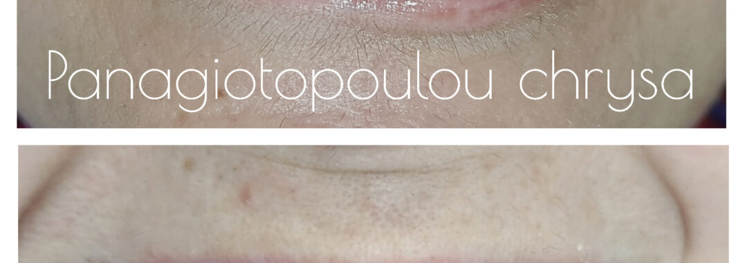 πριν και μετά αποκατάσταση δοντιών Καρδίτσα