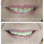 πριν και μετά αποκατάσταση δοντιών Καρδίτσα