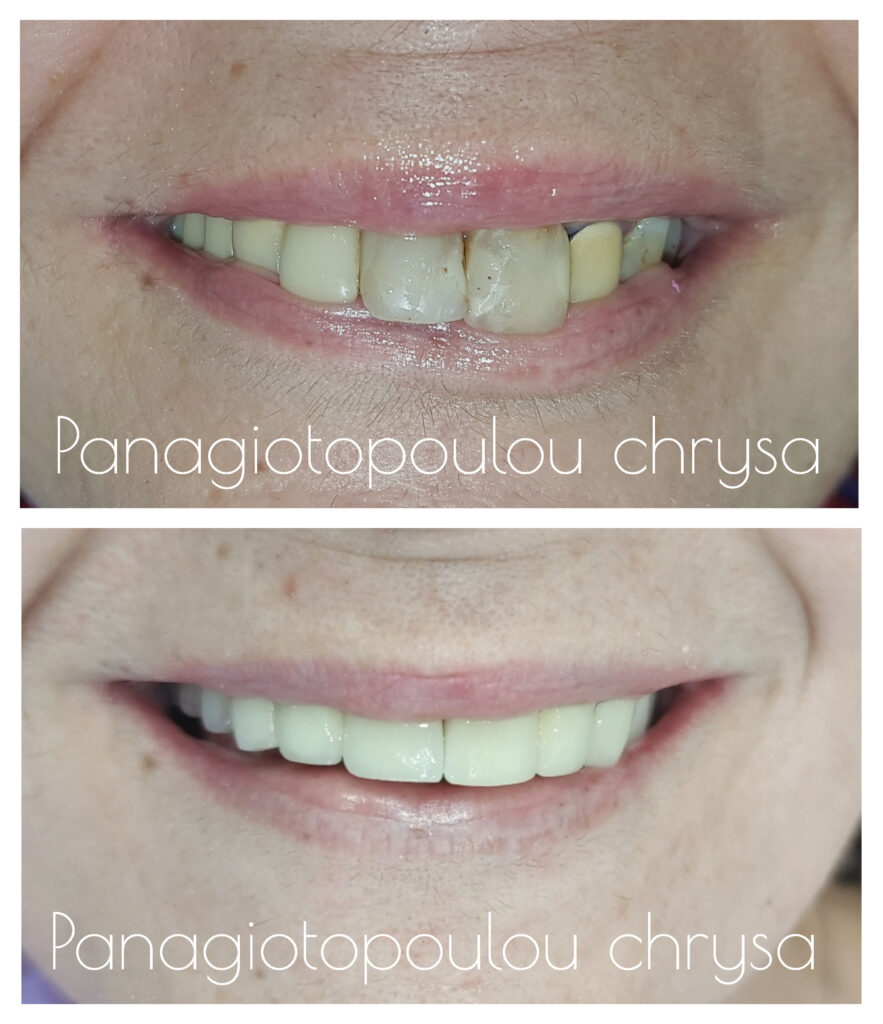 πριν και μετά αποκατάσταση δοντιών Καρδίτσα